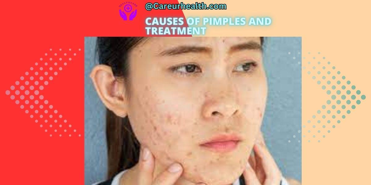 Causes of pimples | Acne and treatment