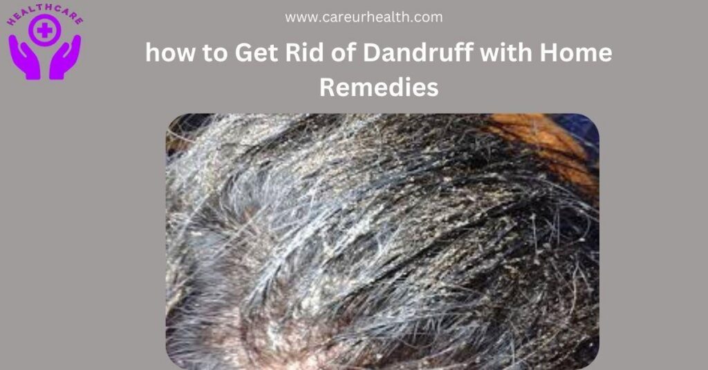 how to Get Rid of Dandruff with Home Remedies