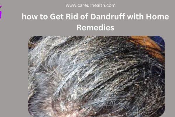 Effective and Natural Solutions on How to Get Rid of Dandruff with Home Remedies