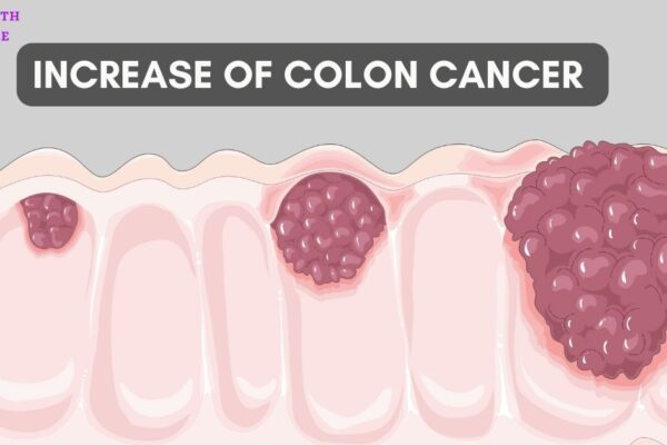 Increase in colon cancer 