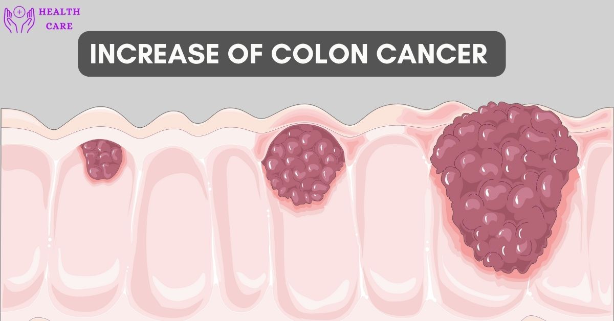 Increase in colon cancer 