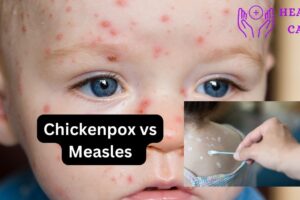 Treatment and symptoms of chickenpox vs measles  