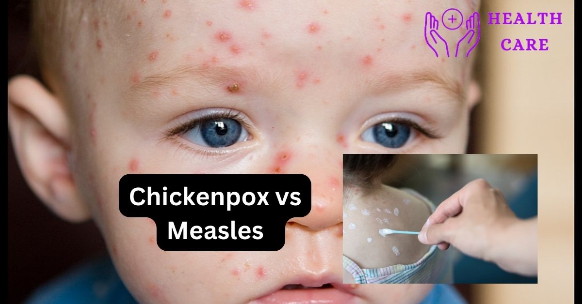 Treatment and symptoms of chickenpox vs measles  