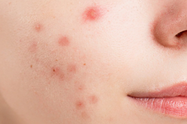 SUPRISING CAUSES OF ADULT ACNE AND GET RIDS