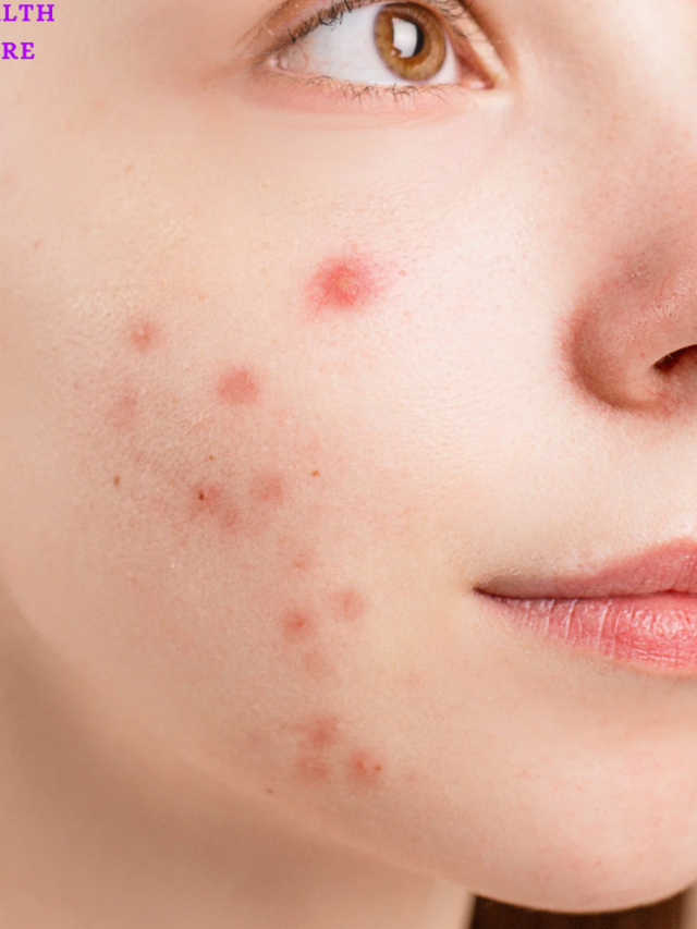 SUPRISING CAUSES OF ADULT ACNE AND GET RIDS